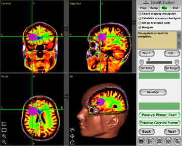 Brain Surgery Navigation and Planning Tools | Bangkok International ...