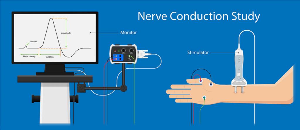 ตรวจเส้นประสาทและกล้ามเนื้อด้วยไฟฟ้า