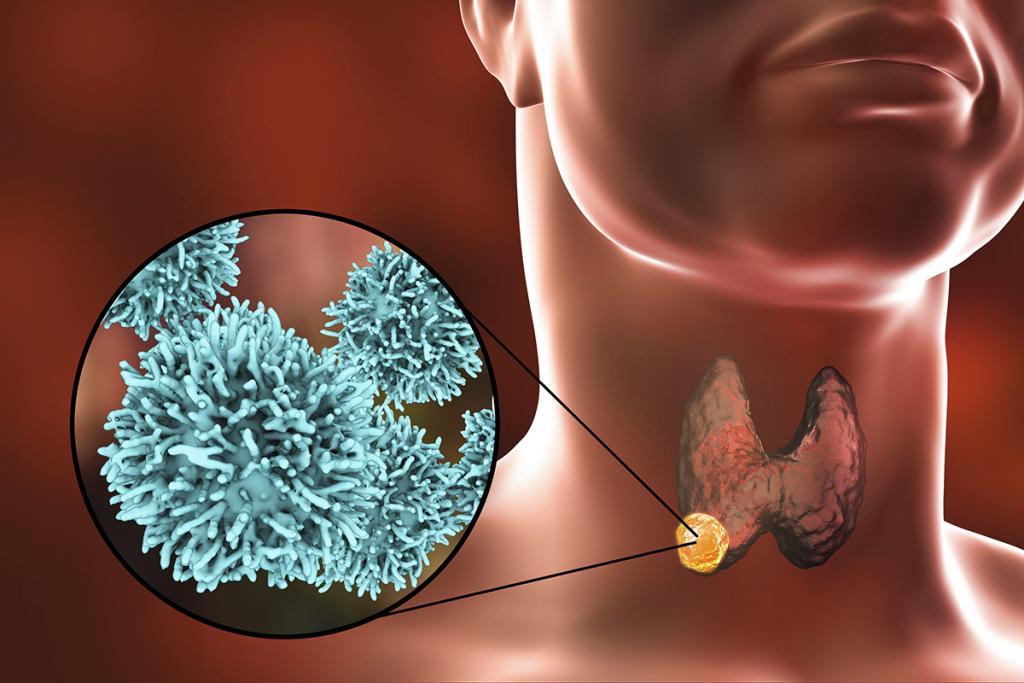 甲状腺がんを早期に発見