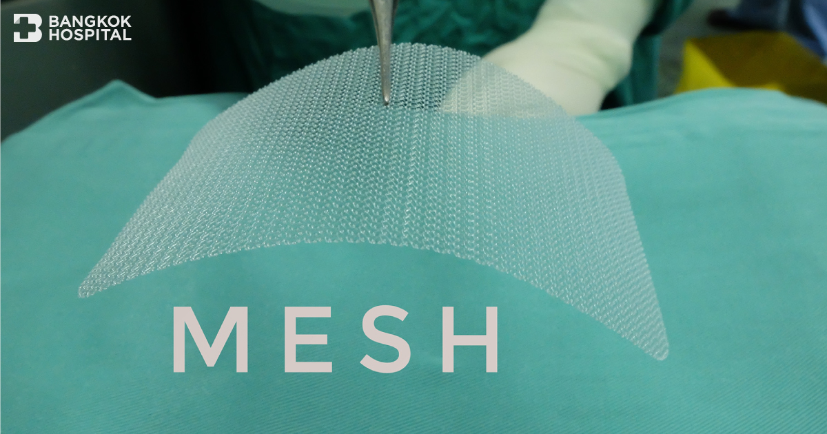 Technology MESH Repair เสริมความแข็งแรง ป้องกันไส้เลื่อนซ้ำ