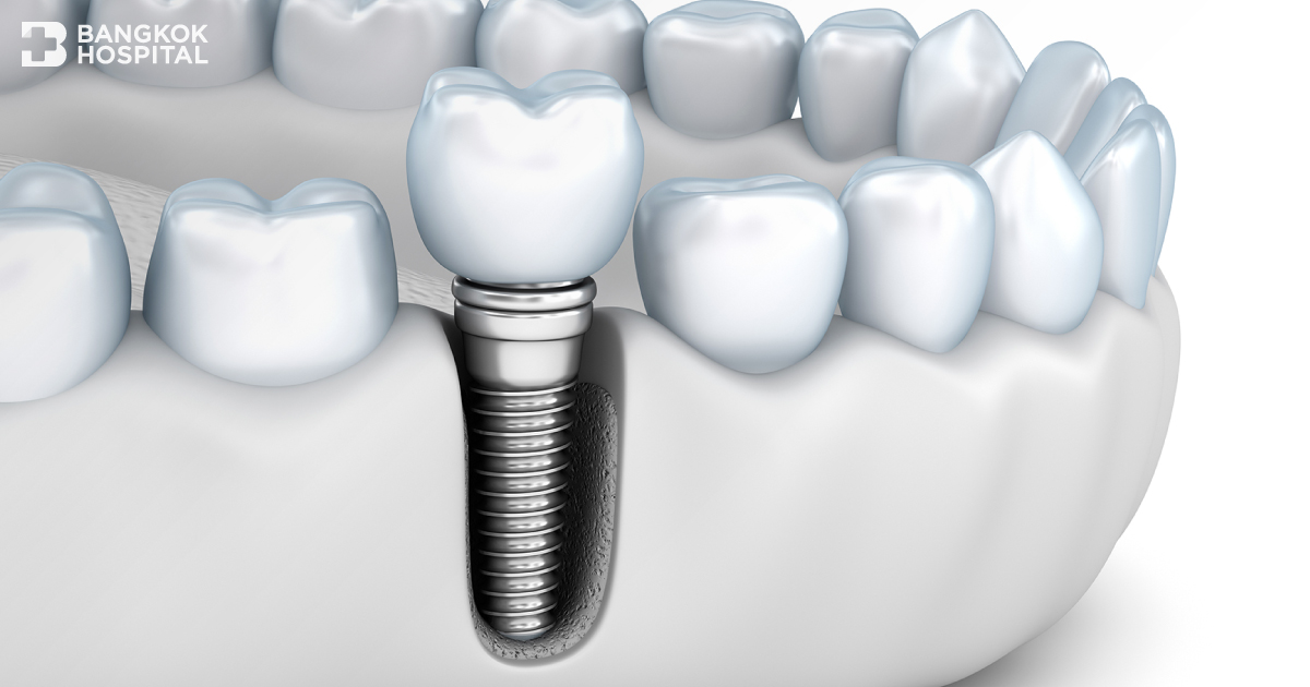 Smartlife: Innovative Computer Guided Implant Surgery