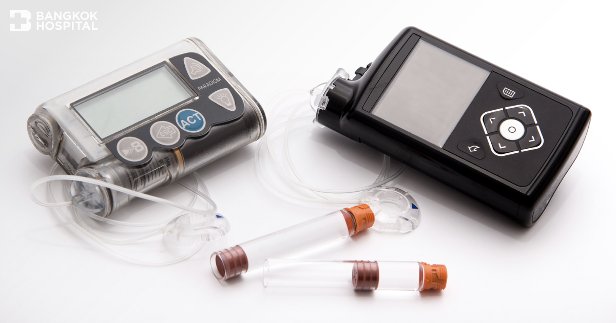 ทำความรู้จักกับอินซูลินปั๊ม (Insulin Pump)