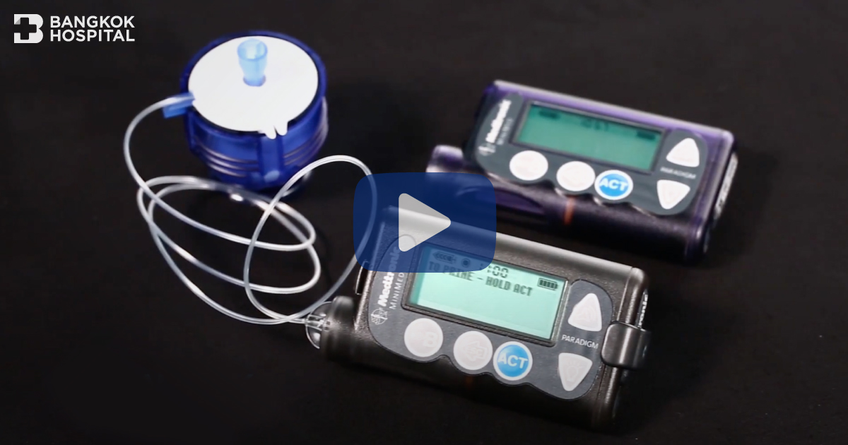 Insulin Pump ជួយគ្រប់គ្រងជាតិស្ករក្នុងឈាម។ សម្រាប់អ្នកជំងឺទឹកនោមផ្អែម