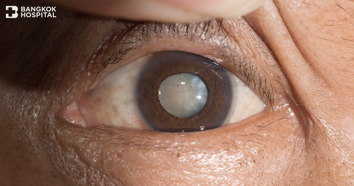 Cataracts: Causes and Essential Factors to Be Aware Of