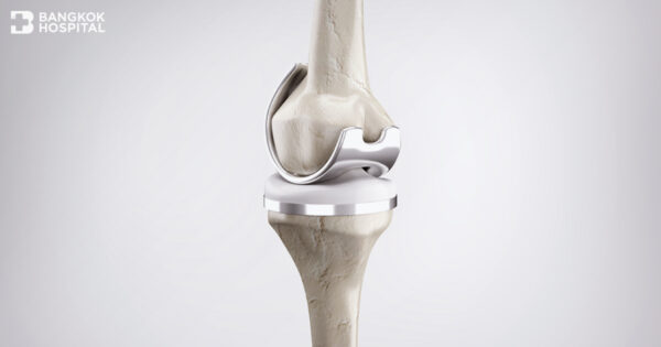 人工膝関節置換術 全人工膝関節置換術用人工膝関節 - FHK® - FH Orthopedics
