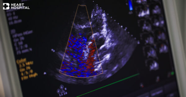 การตรวจหัวใจด้วยเครื่องสะท้อนเสียงความถี่สูง (Echocardiogram) Image