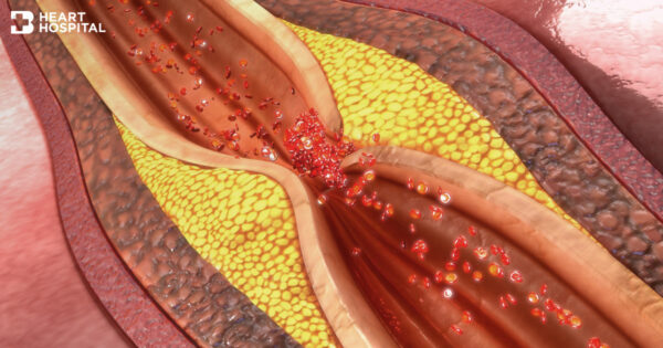 Coronary Intervention 11ー4 特集:冠動脈分岐部病変のすべて 福島県立医科大学 循環器内科学講座 教室について 研究部門紹介