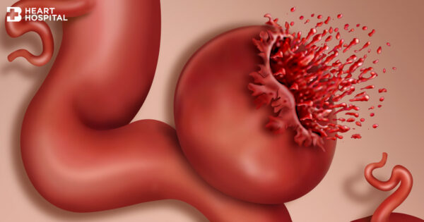 เส้นเลือดแดงโป่งพองแตกเซาะ มาทันเวลาเพิ่มโอกาสรอด 