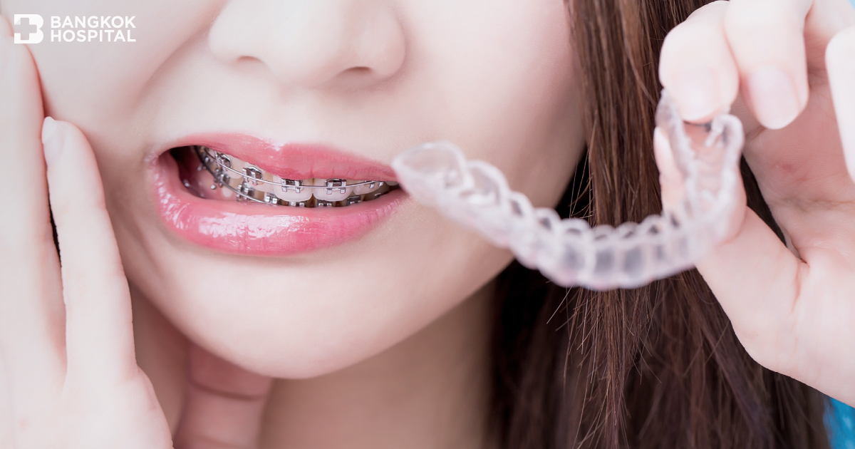 Invisalign Debonding 解决了牙齿矫正金属问题，无需重新开始计数。