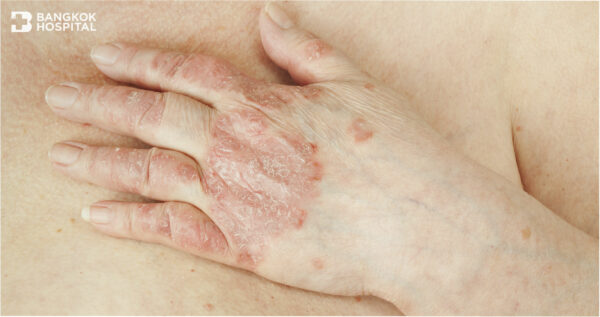 ข้ออักเสบสะเก็ดเงิน อันตรายถึงขยับไม่ได้ Image