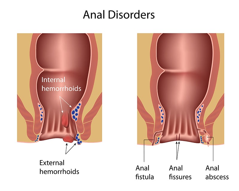 ฝีคัณฑสูตร ติดเชื้อเรื้อรังในทวารหนัก