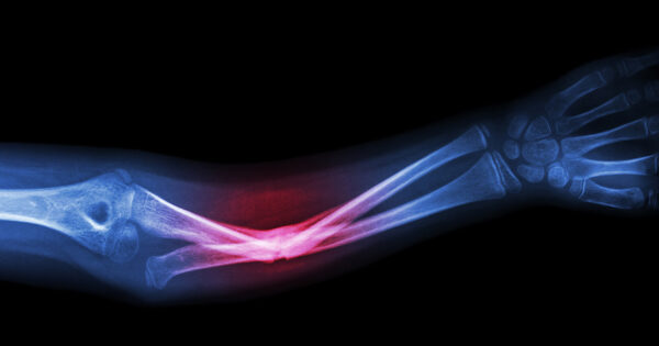 กระดูกหักจากกระดูกพรุน