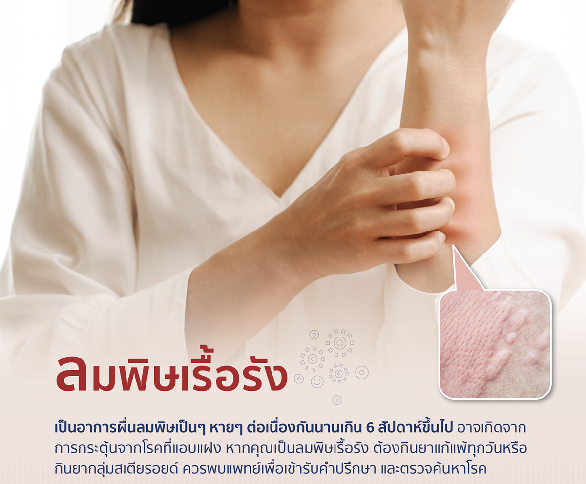 แพ็กเกจตรวจค้นหาโรคลมพิษเรื้อรัง (Chronic Urticaria) Image