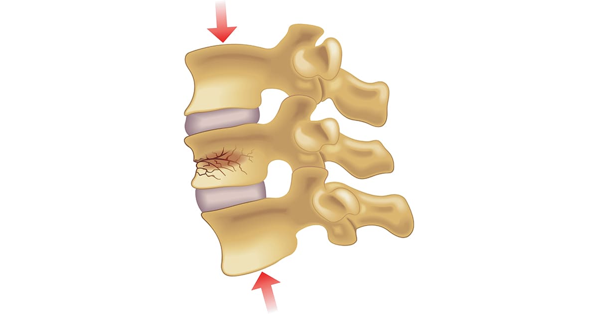 กระดูกสันหลังยุบจากโรคกระดูกพรุน