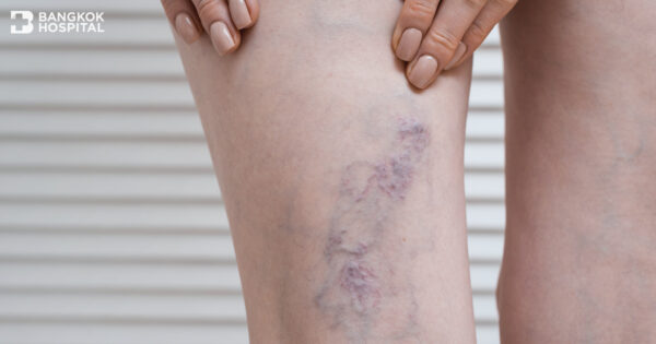 Q&A – Pain of Varicose Veins Image