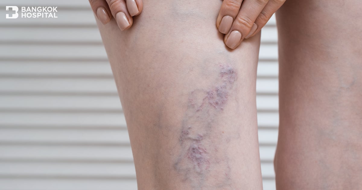 Q&A – Pain of Varicose Veins