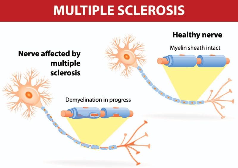 Multiple Sclerosis