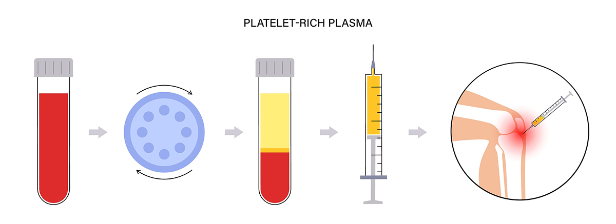 แพ็กเกจฉีดเกล็ดเลือดเข้มข้น PRP