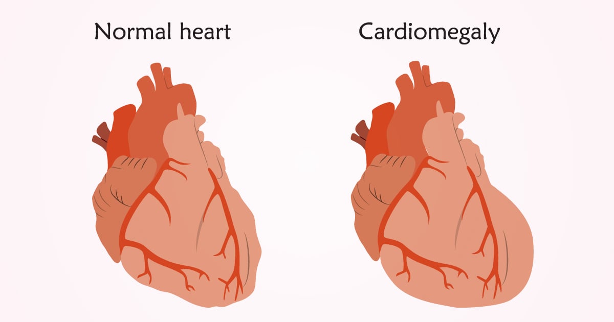 ภาวะหัวใจโต ดูแลให้ทันก่อนเป็นหนัก