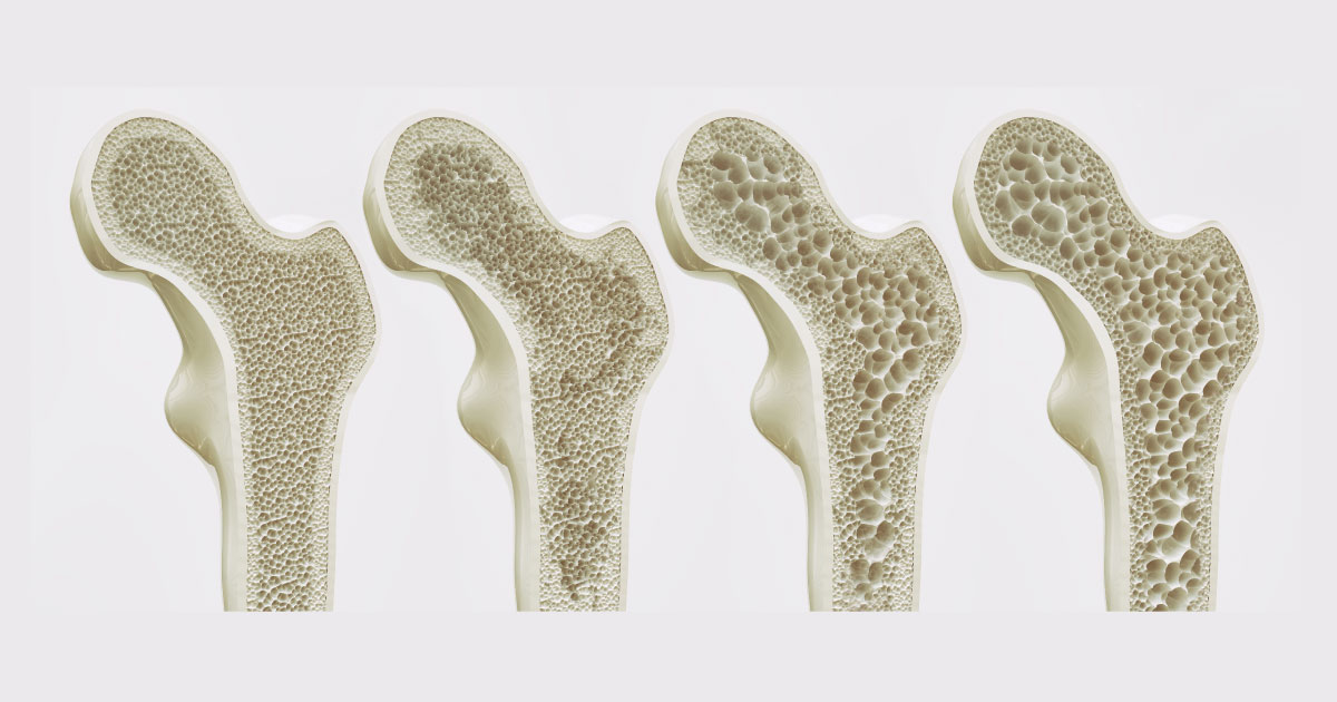 แพ็กเกจตรวจคัดกรองกระดูกพรุนเชิงลึกในผู้สูงอายุ