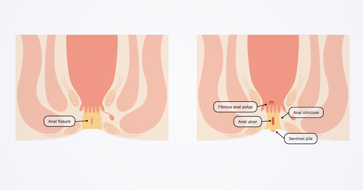 Botulinum Toxin treats chronic anal fissures without surgery