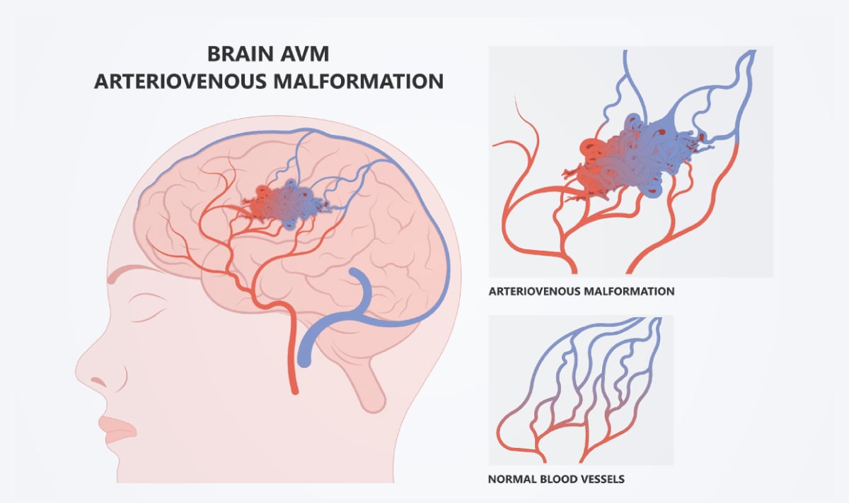 หลอดเลือดสมองผิดปกติเอวีเอ็ม (AVM) อันตรายรุนแรง