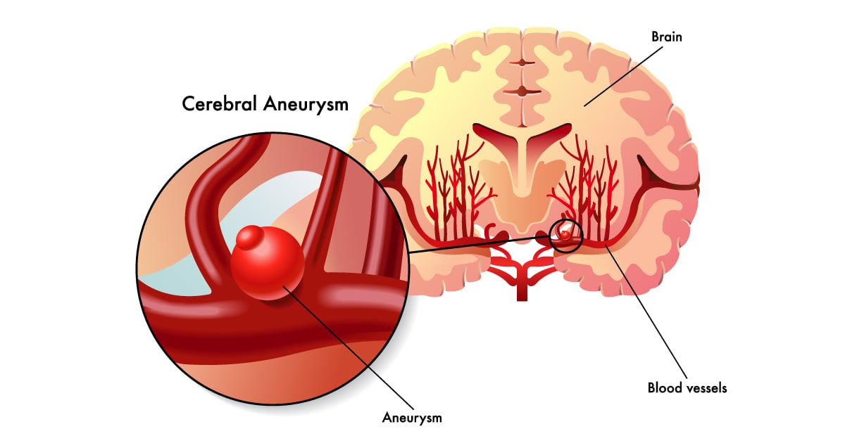 Brain aneurysm - a silent threat that requires fast treatment before it becomes life-threatening