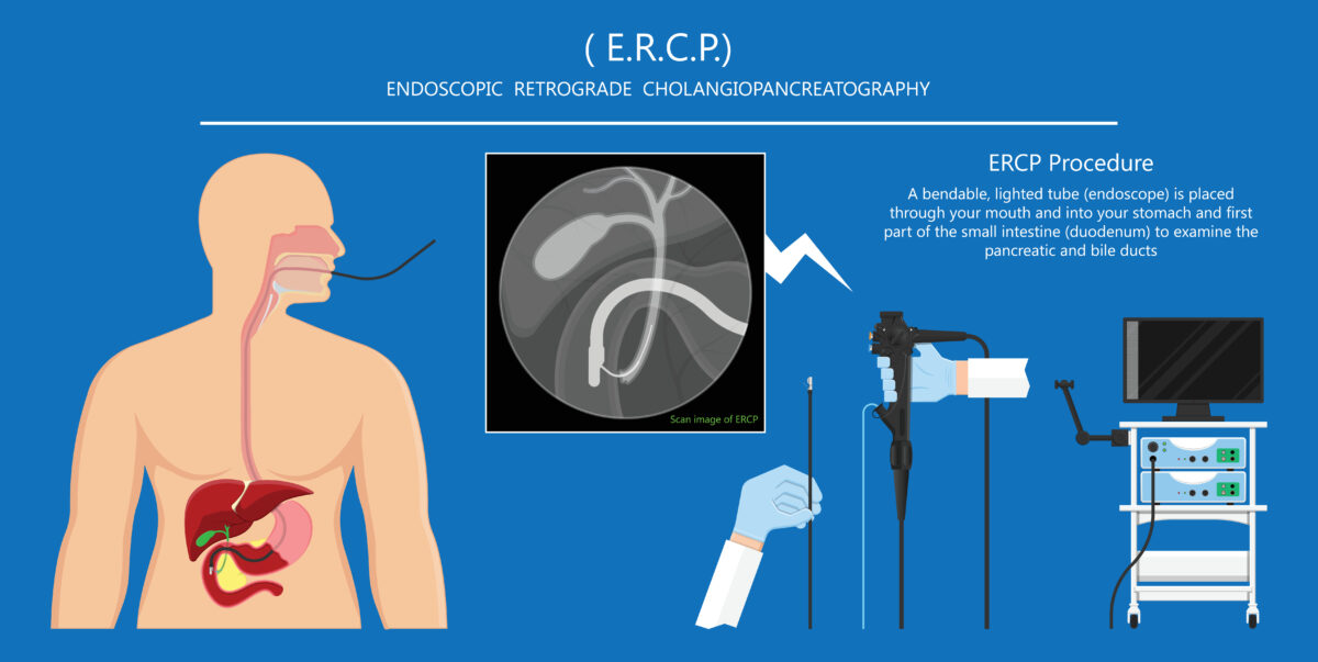 فحص ERCP بالمنظار للقناة الصفراوية والبنكرياس