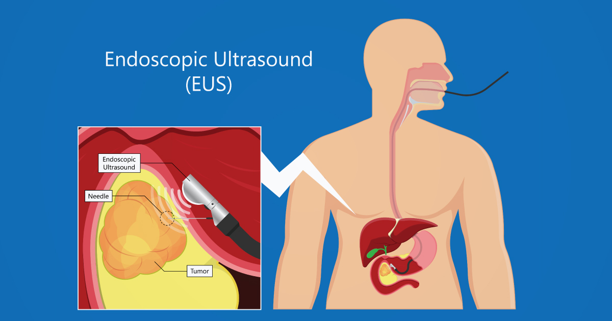 EUS ตรวจส่องกล้องอัลตราซาวนด์เช็กระบบทางเดินอาหาร