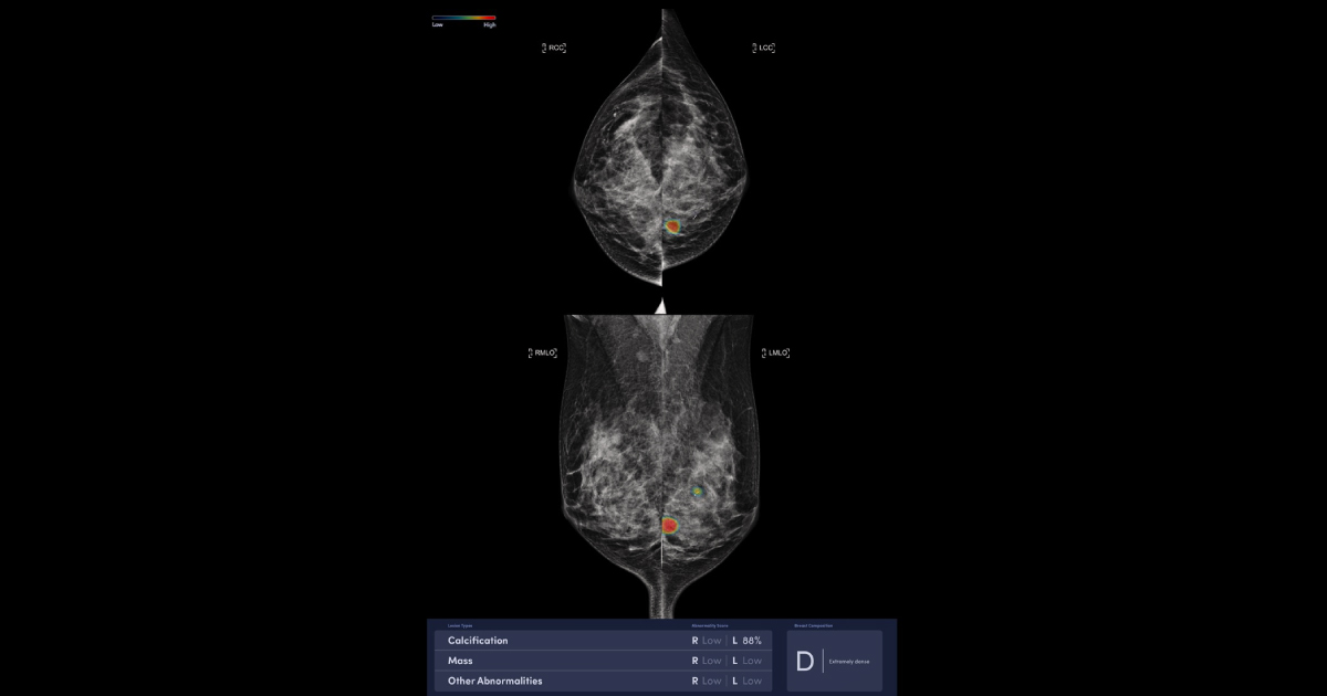 AI MAMMOGRAPHY เพิ่มประสิทธิภาพการตรวจมะเร็งเต้านม