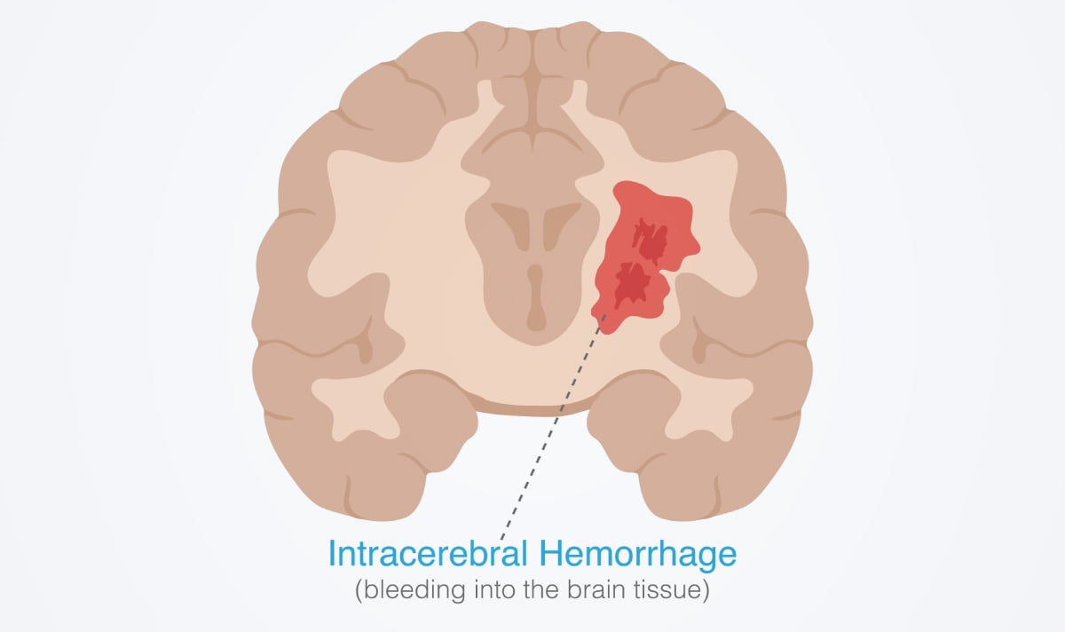เลือดออกในสมอง อันตรายร้ายแรงถึงชีวิต