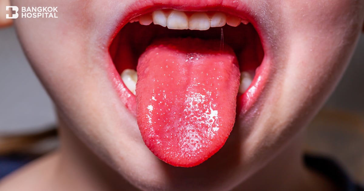 Scarlet fever is easily contagious among children, so caution is necessary.