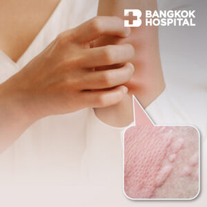 Campaign แพ็กเกจตรวจค้นหาโรคลมพิษเรื้อรัง (Chronic Urticaria) Image