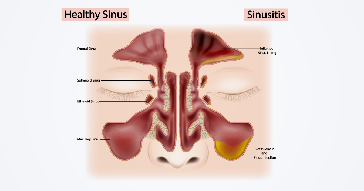 វិធីព្យាបាលជំងឺរលាក sinusitis ដើម្បីកុំឱ្យវាកាន់តែធ្ងន់ធ្ងរ
