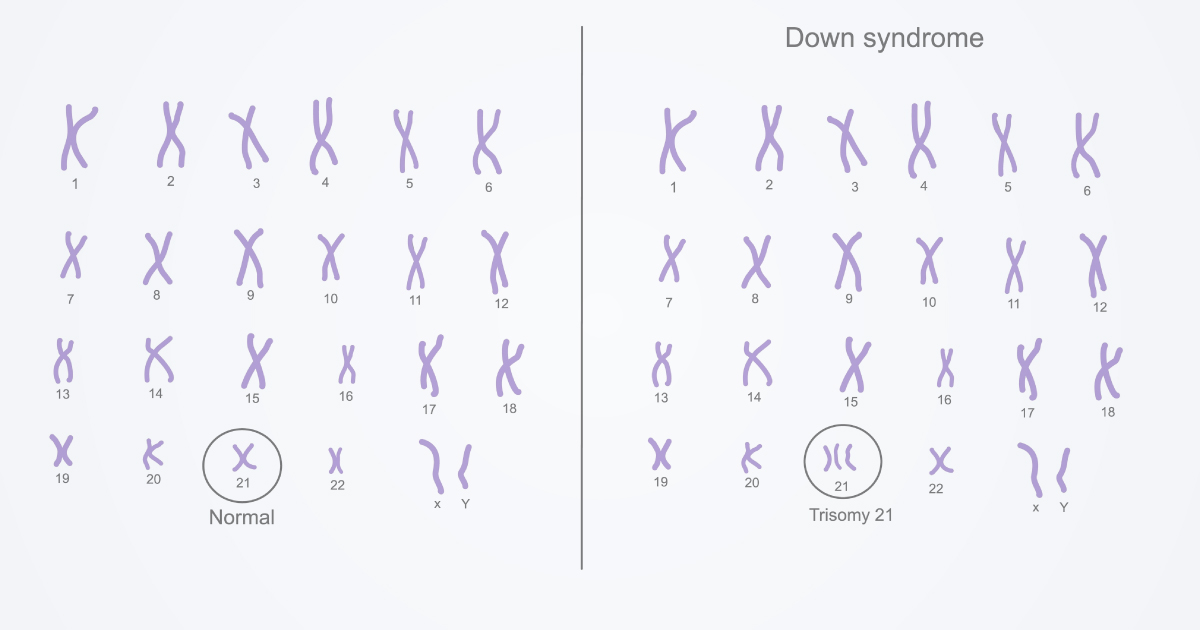 ไม่อยากให้ลูกเป็นดาวน์ซินโดรมต้องทำอย่างไร