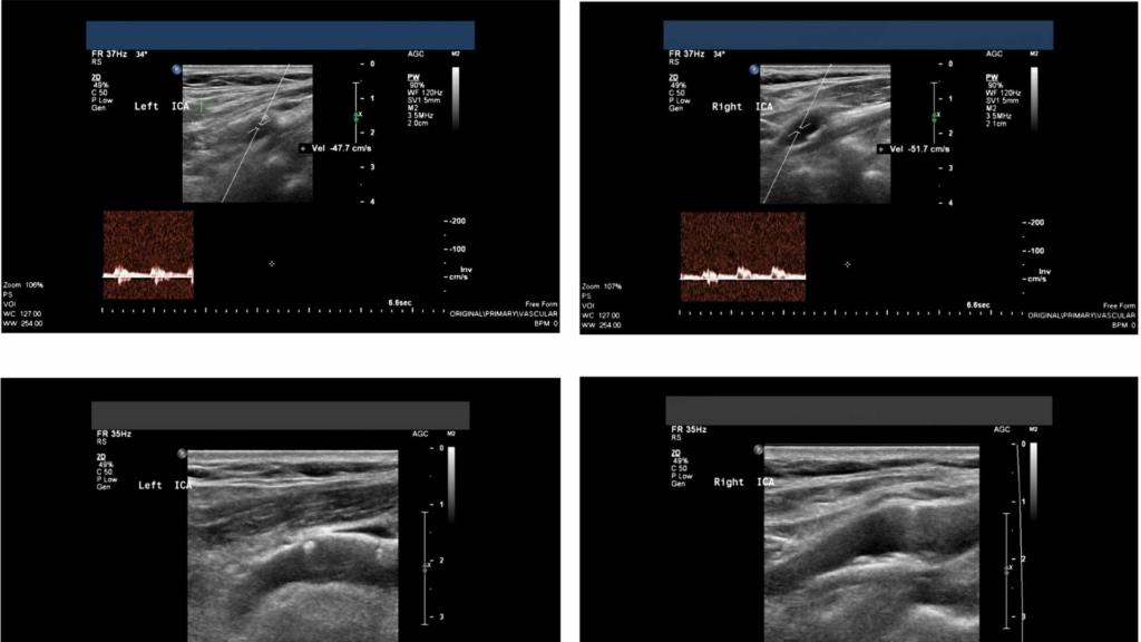 Ultrasound Carotid โรงพยาบาลกรุงเทพเชียงใหม่