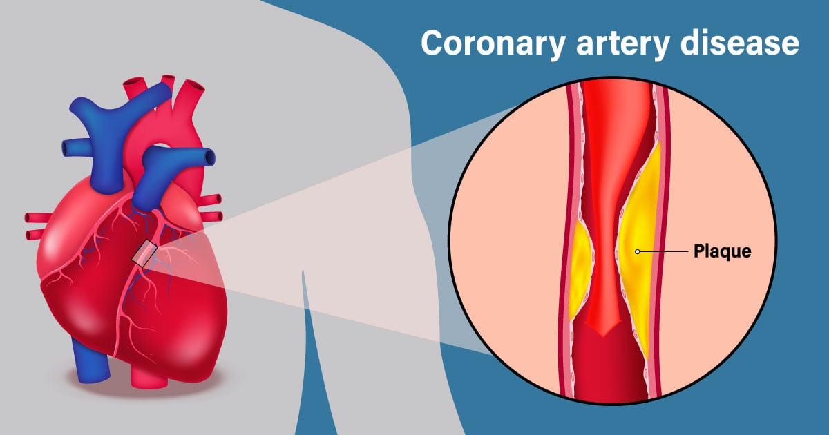 ผ่าตัดบายพาสหลอดเลือดหัวใจแผลเล็ก MICS CABG