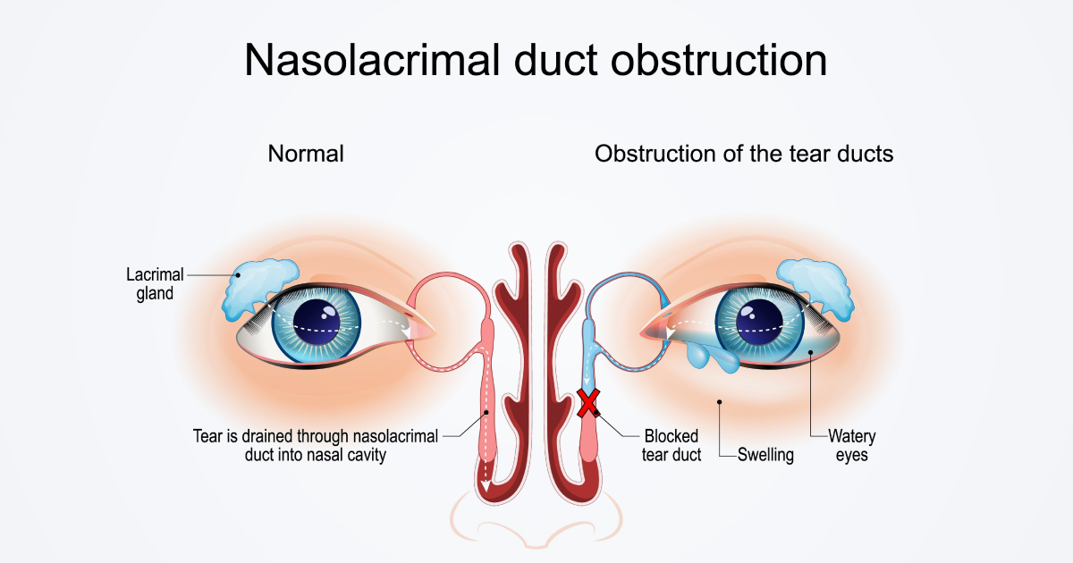 ท่อน้ำตาตันในผู้ใหญ่