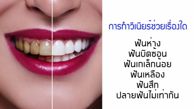 มั่นใจฟันสวยด้วย “วีเนียร์ VENEER” Image