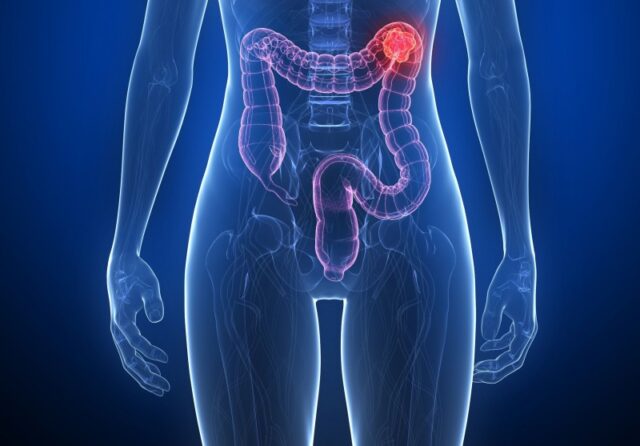 Preventing GI Cancers Image