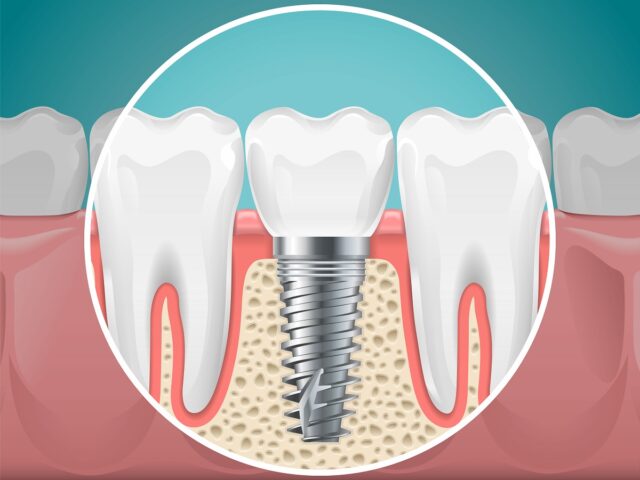 "Dental Implants" Bringing Back Your Confident Smile Image