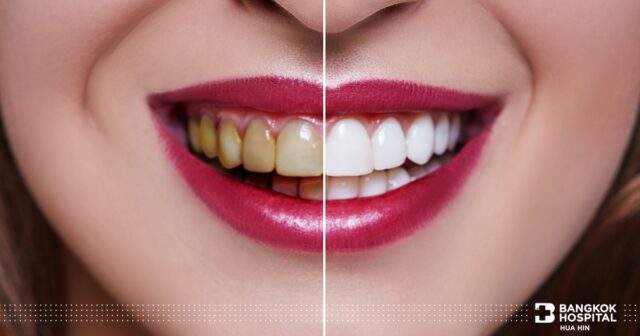 Confident Smiles with "DIGITAL VENEER" Image