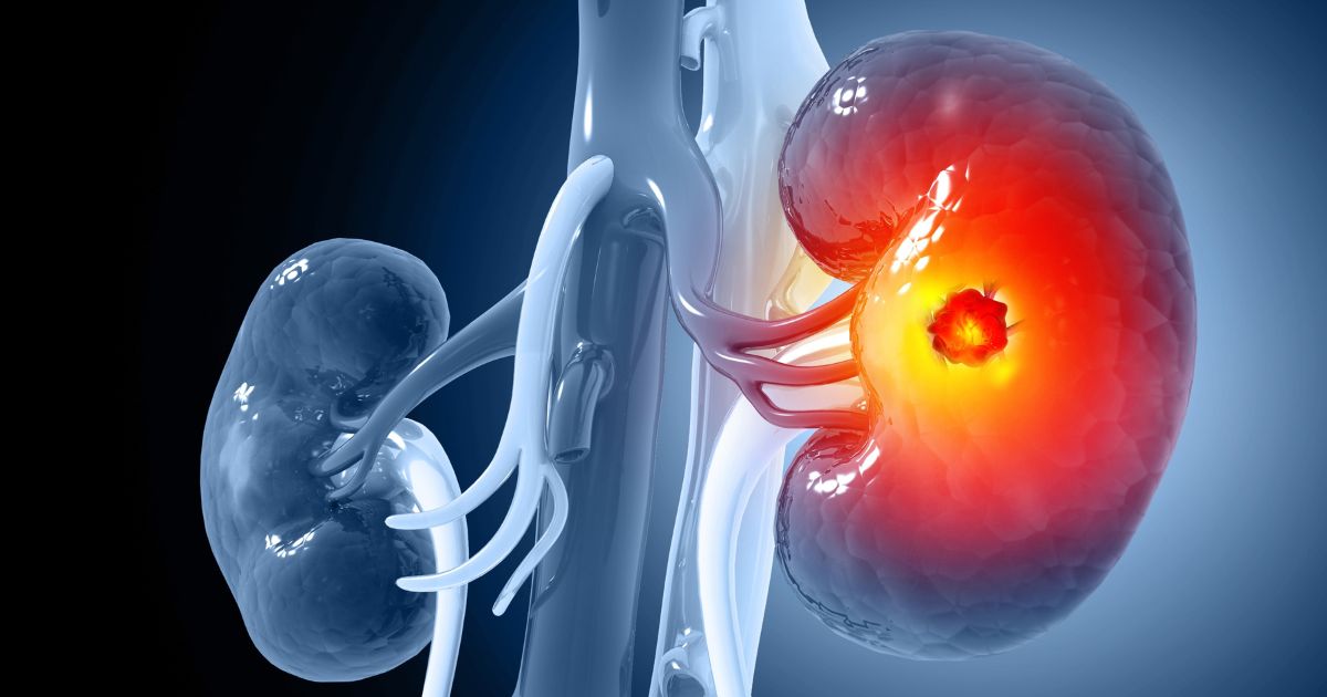 Kidney cancer