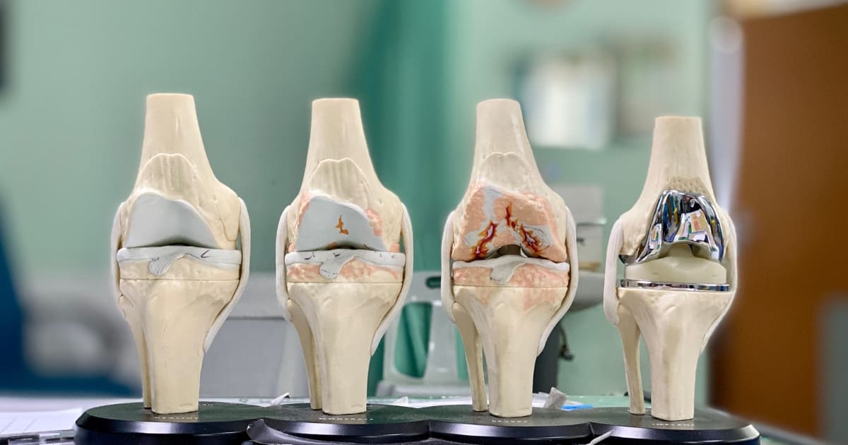 เข่าบวมในผู้สูงอายุ สัญญาณเตือนข้อเข่าเสื่อม