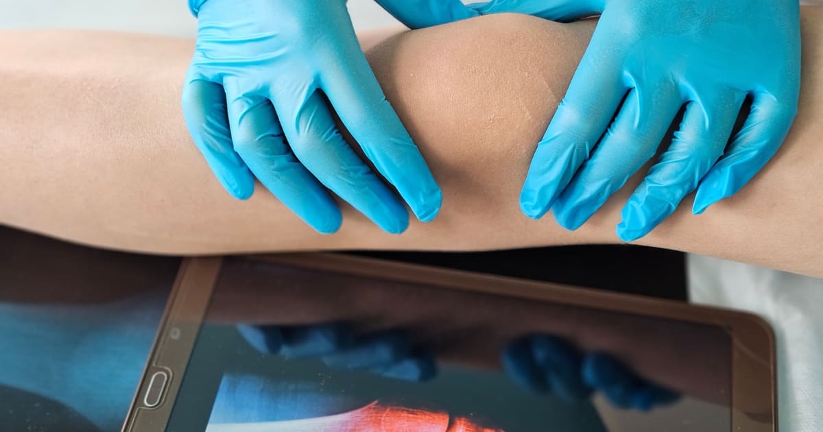 เข่าบวมในผู้สูงอายุ สัญญาณเตือนข้อเข่าเสื่อม