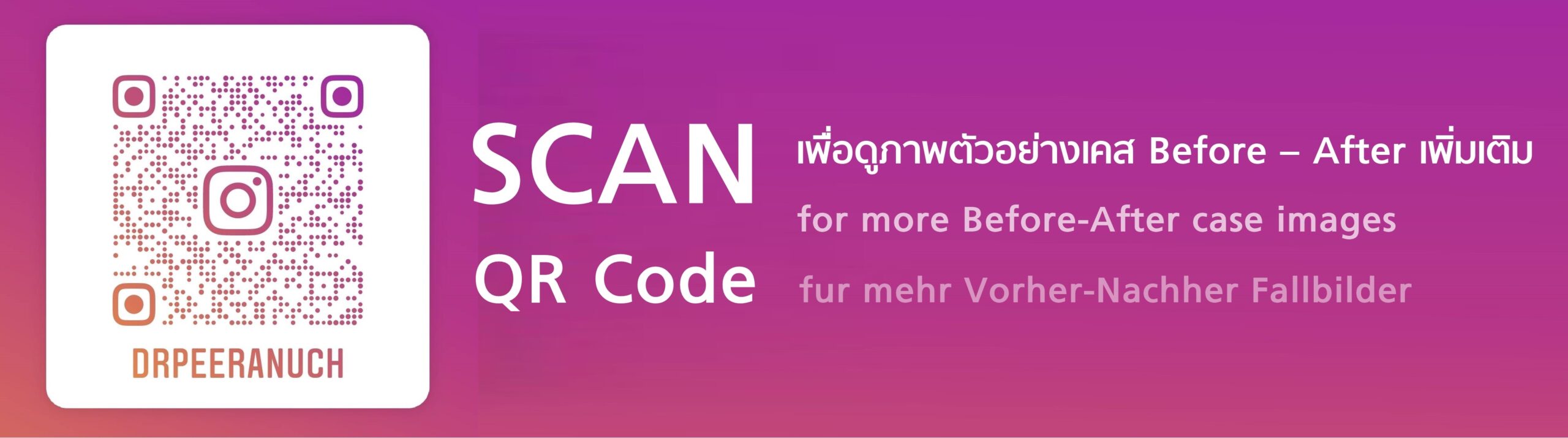 QR-Code scannen für mehr Vorher-Nachher Fallbilder