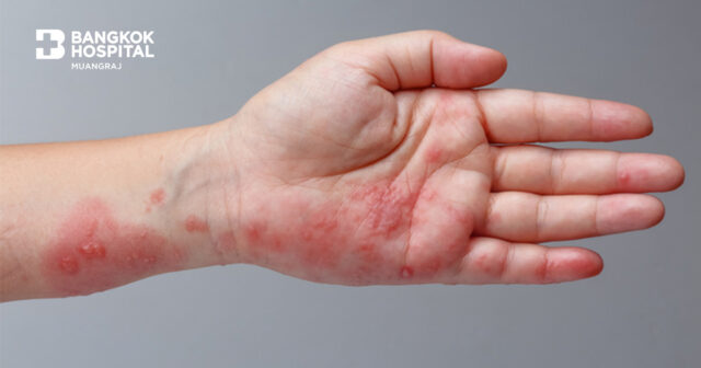 รู้เท่าทัน.."โรคงูสวัด"