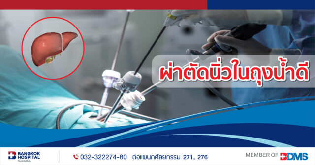 แพ็กเกจผ่าตัดนิ่วถุงน้ำดี