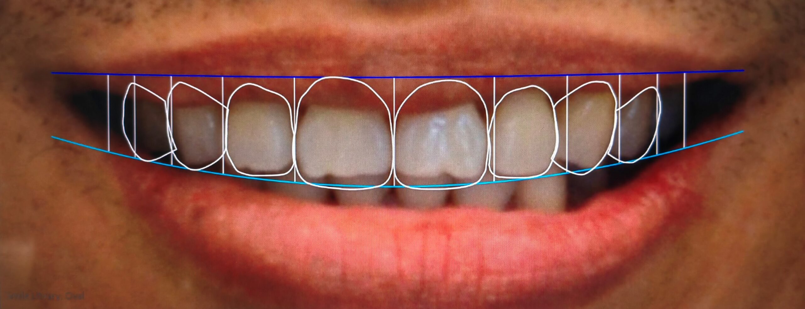 Digital Smile Design