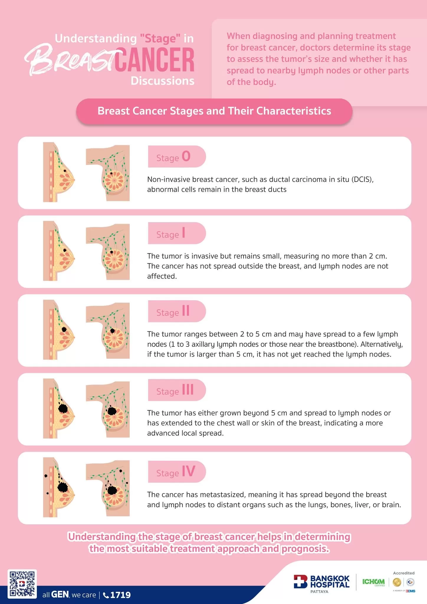 Understanding The Different Stages Of Breast Cancer YYSJME Understanding The Different Stages Of Breast Cancer YYSJME